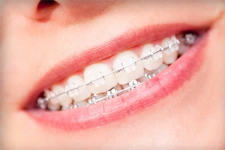 ortodoncia estetica